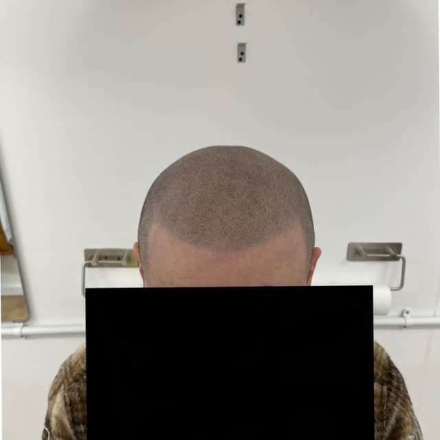 Scalp micropigmentation result by Micro Magic SMP Manchester