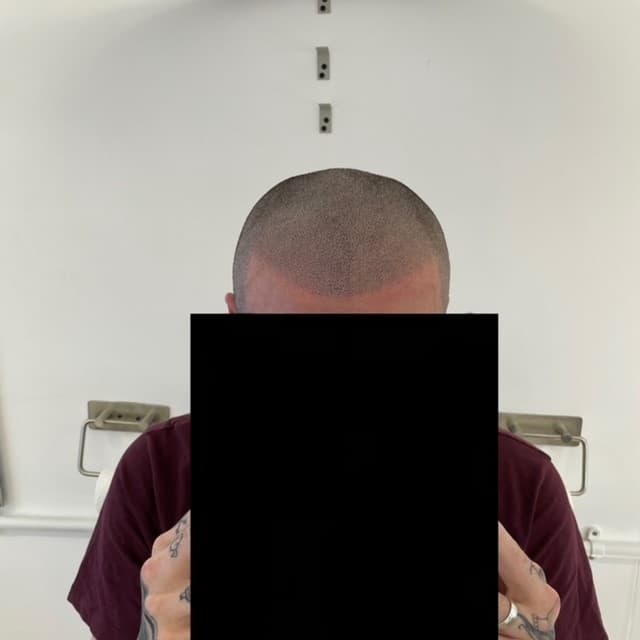 Scalp micropigmentation result by Micro Magic SMP Manchester