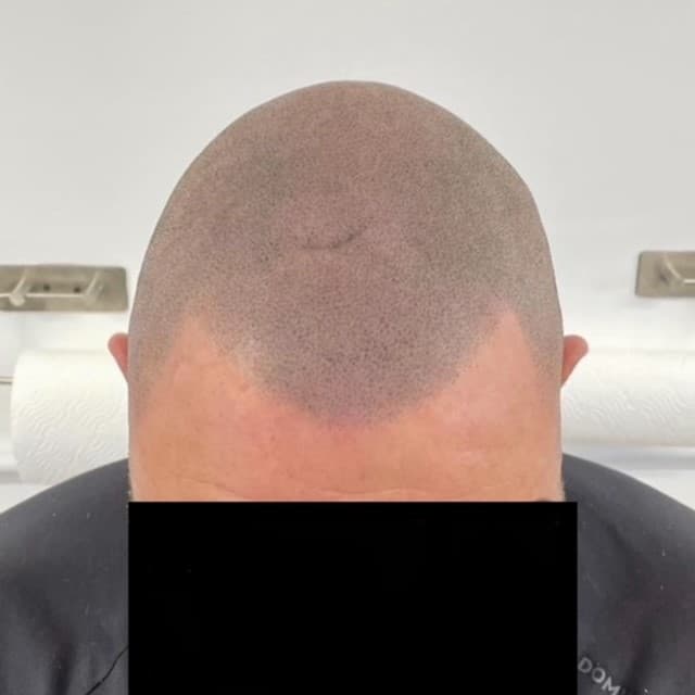 Scalp micropigmentation result by Micro Magic SMP Manchester