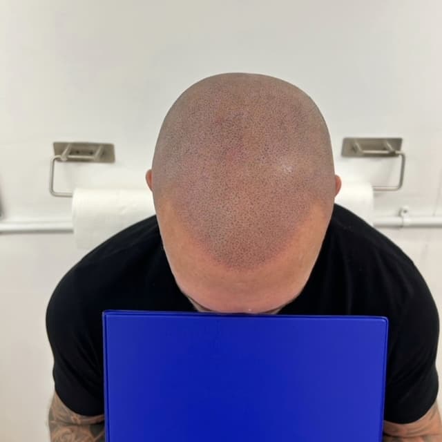 Scalp micropigmentation result by Micro Magic SMP Manchester