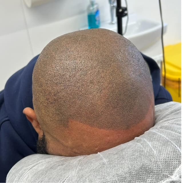 Scalp micropigmentation result by Micro Magic SMP Manchester