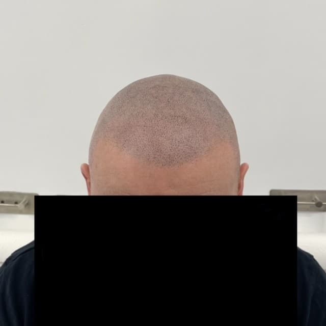 Scalp micropigmentation result by Micro Magic SMP Manchester