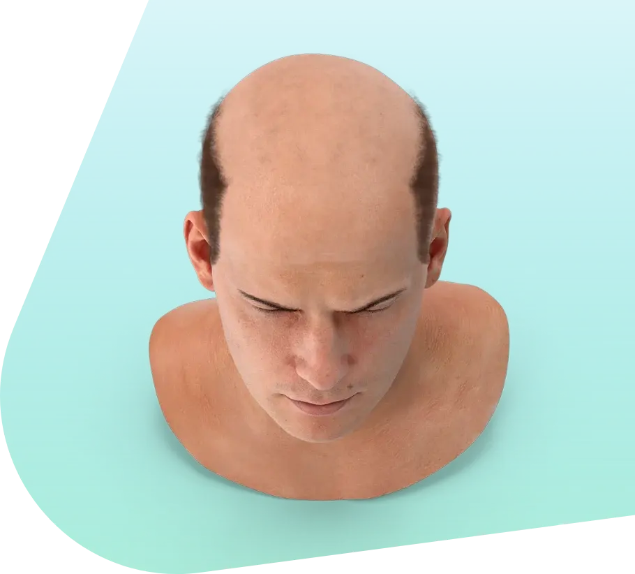 Stuart Buckley at work, SMP for baldness