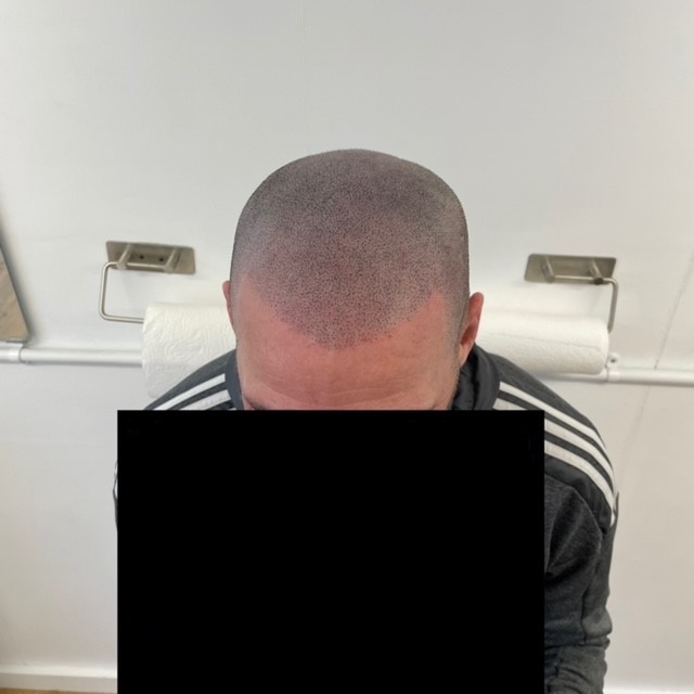 Scalp micropigmentation result by Micro Magic SMP Manchester