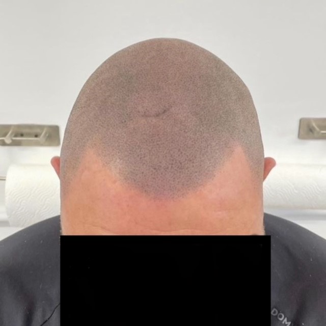 Scalp micropigmentation result by Micro Magic SMP Manchester