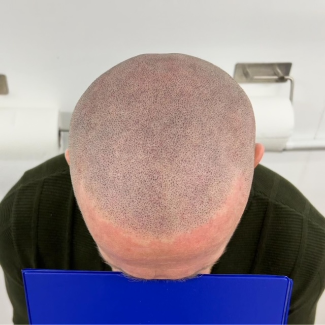 Scalp micropigmentation result by Micro Magic SMP Manchester