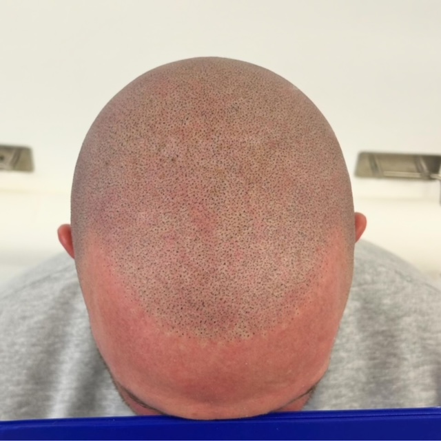 Scalp micropigmentation result by Micro Magic SMP Manchester