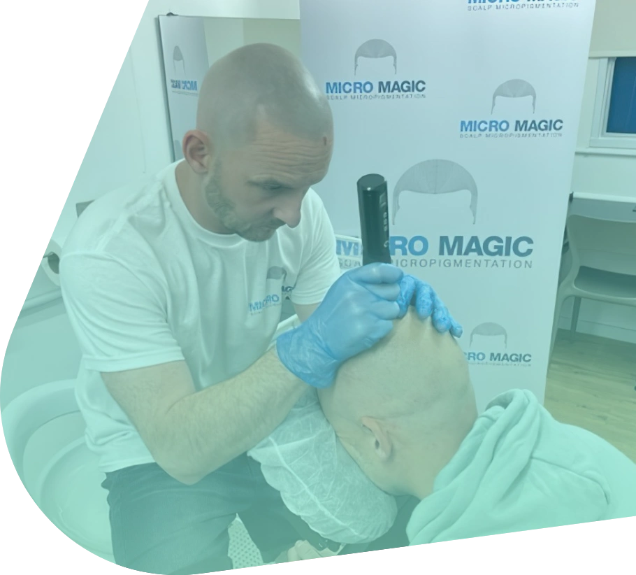 Stuart Buckley carrying out a scalp micropigmentation treatment
