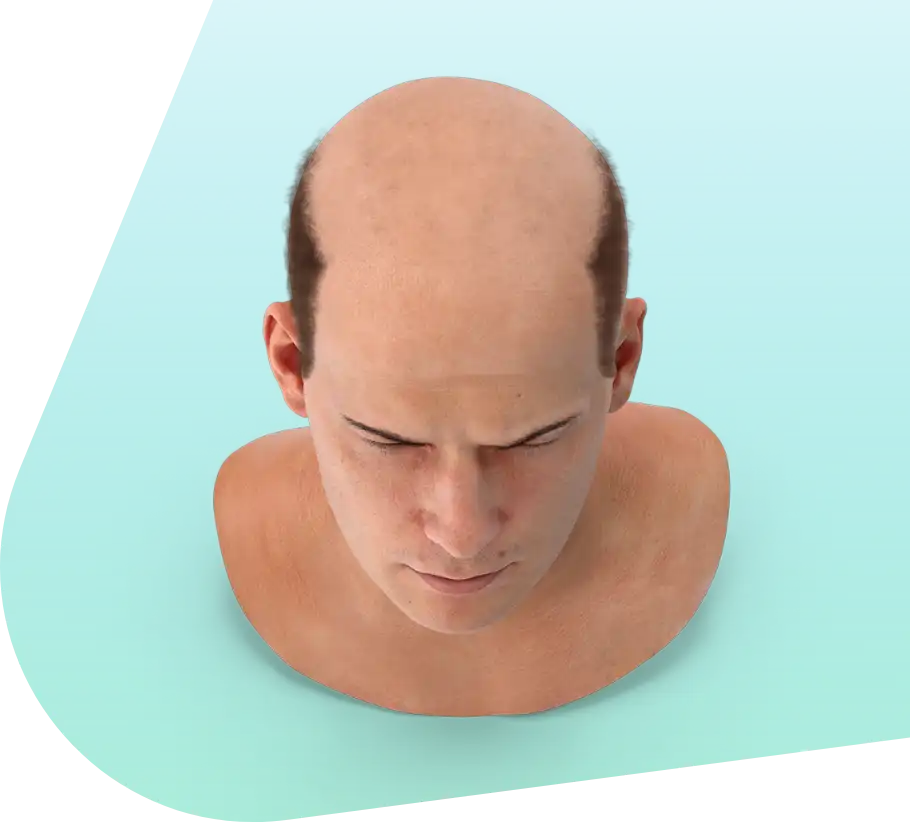 Illustration of male pattern baldness on the crown and temples